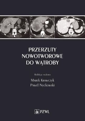 Przerzuty nowotworowe do wtroby Marek Krawczyk, Pawe Nyckowski - okadka ebooka